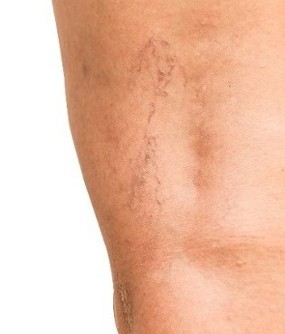 Leg Veins