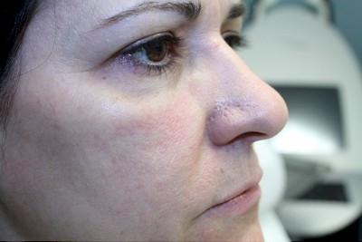After, Inner Cheeks Lifted with Volume Restoration