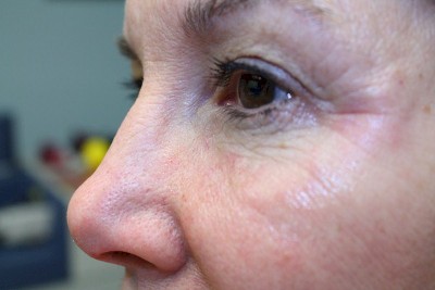Immediately After, Softening Of Bags,Tightening of Skin and Improvement in Crow’s Feet