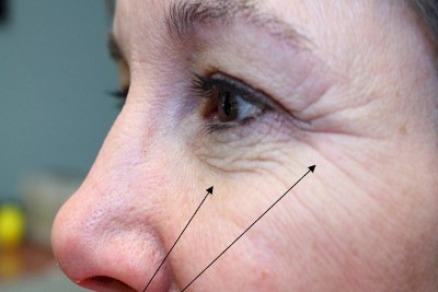Before, Under Eye Bags, Loose Skin and Crow’s Feet