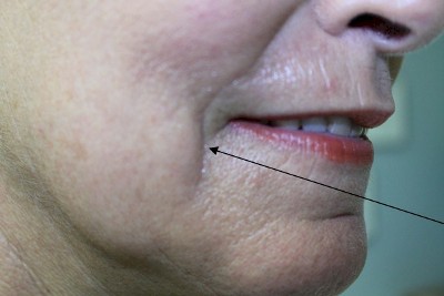 Before, Deep Volume Loss Around Mouth