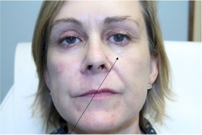 After Treatment