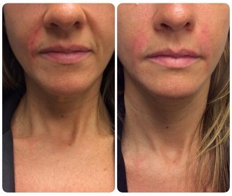 Before and After Nasolabial Folds