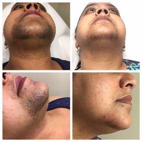 Before & After Hyperpigmentation