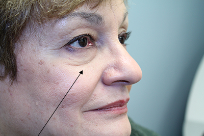 Before, Under Eye Bags, Loose Tissue