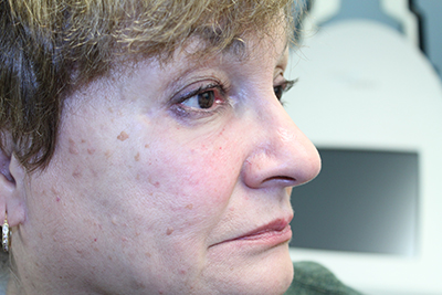 After Under Eye Correction