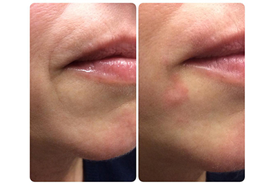 Before and After Side Lip