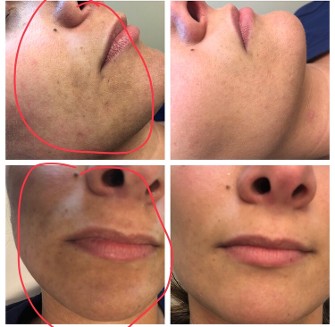 Before and After Clear+Brilliant Laser Treatment