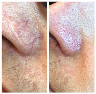 Before and After Laser Treatment
