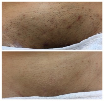 Before and After Laser Hair Removal Treatment with Dark Hair