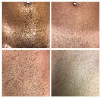 Before & After Laser Treatments